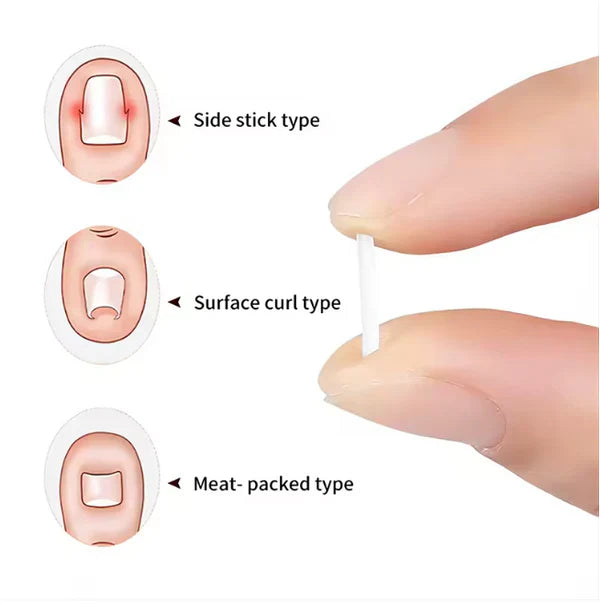 Paski korekcyjne do paznokci u stóp