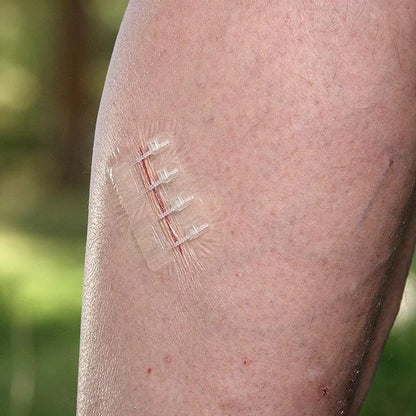 Zestaw do zamykania ran Everlit – 2 szt., paski bez szwów